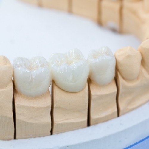 Model smile with dental crown supported bridge
