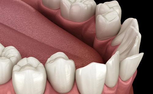 Illustration of crooked teeth