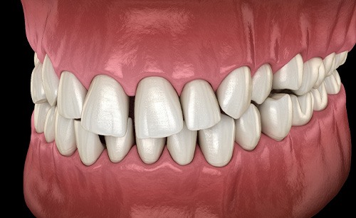 Illustration of gapped teeth