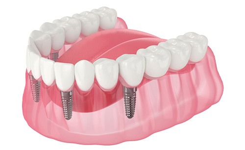 Illustration of implant denture