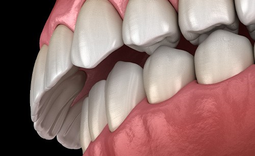 Illustration of an overbite