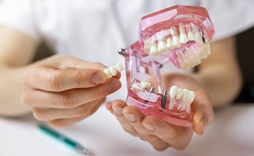 a dentist holding a model of dental implants