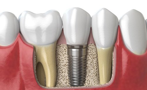 a 3D illustration of a dental implant fusing to the jawbone