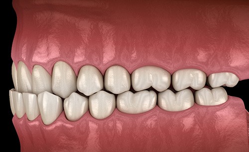 Illustration of an underbite