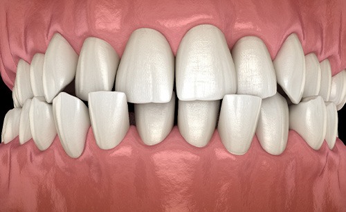 Illustration of a crossbite