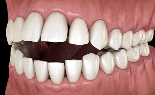 Illustration of an open bite