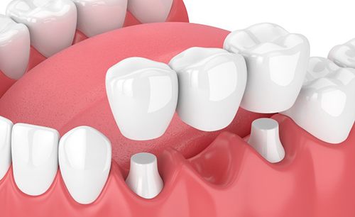 Illustration of traditional dental bridge
