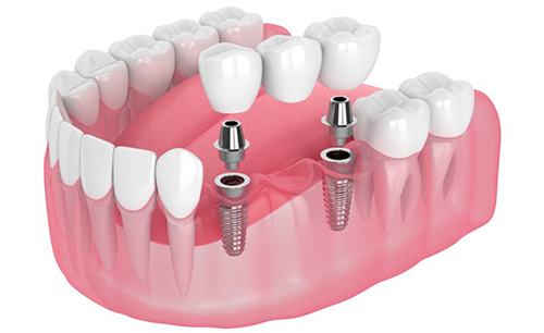 Illustration of implant bridge?