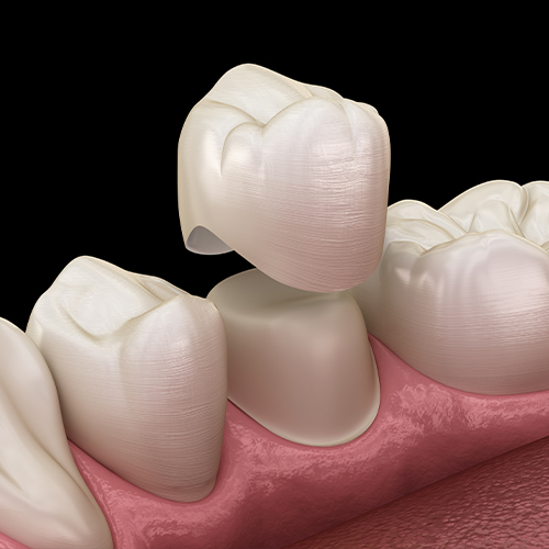 Animated smile during dental crown placement