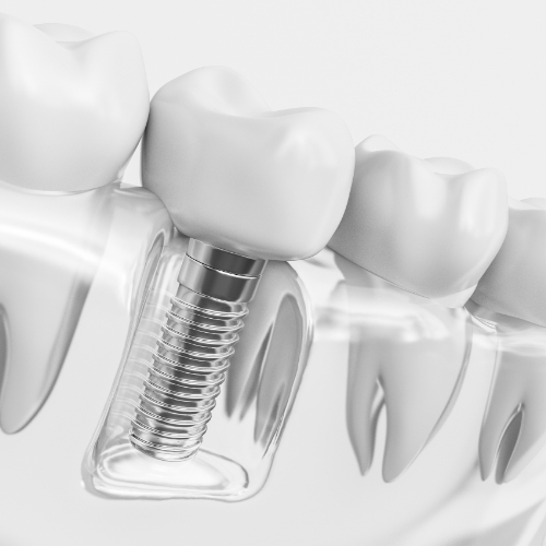 Animated smile with dental implant supported dental crown