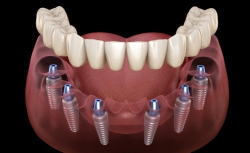 two dental implants supporting a dental bridge 