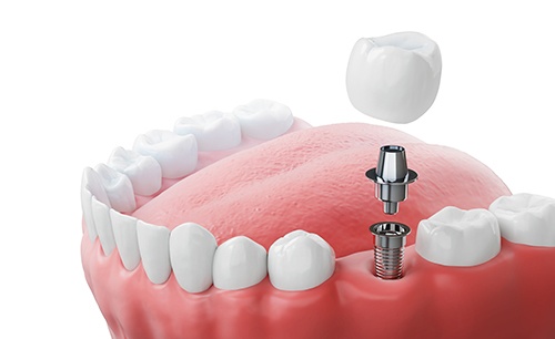Illustration of a single dental implant and its parts in a lower arch with a white background