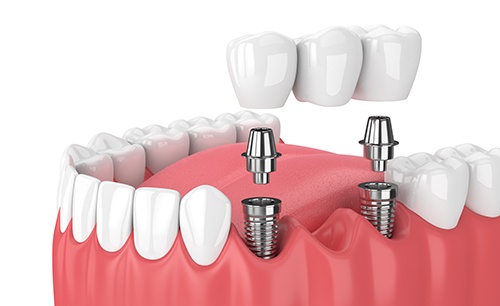 Illustration of dental bridge in lower arch with white background