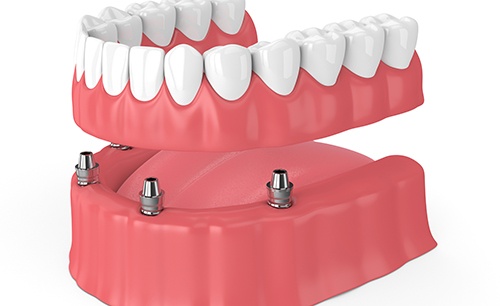 Illustration of implant dentures replacing lower arch of teeth with white background