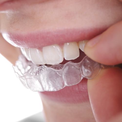 Closeup of dental patient placing Sure Smile clear aligner tray