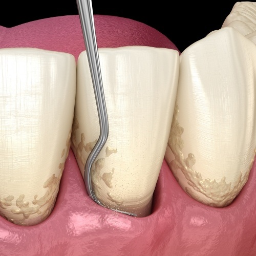 Animated smile during gum disease treatment