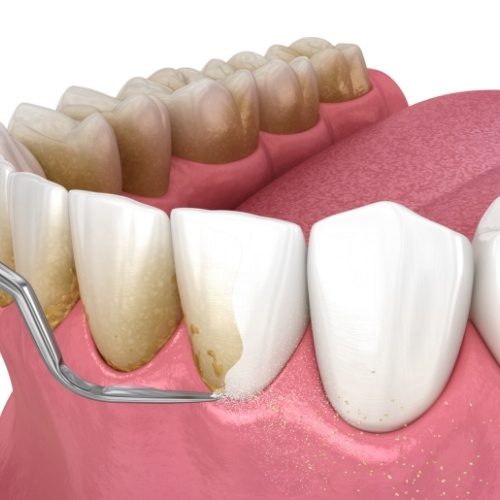 Animated smile during gum disease treatment