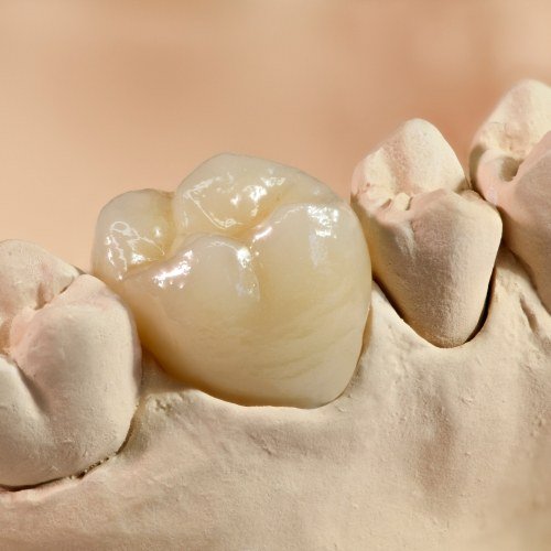 Model smile with dental crown restoration