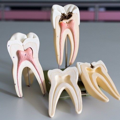 Model of healthy tooth compared to tooth in need of root canal treatment
