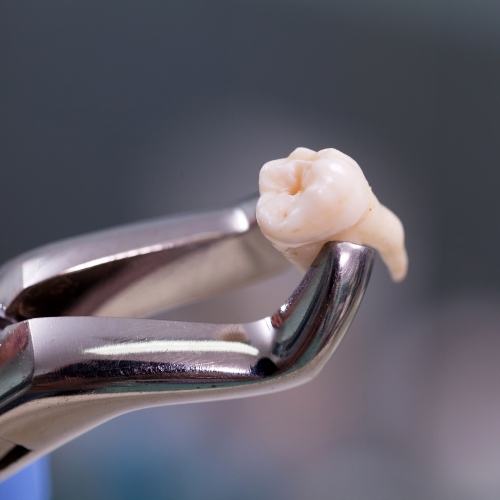 Metal clasp holding a wisdom tooth after extraction