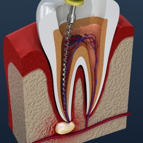 Animated smile during root canal treatment