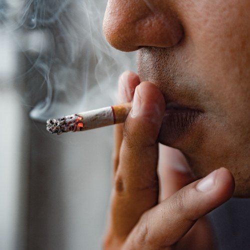 Person smoking which cause tooth staining and need for teeth whitening