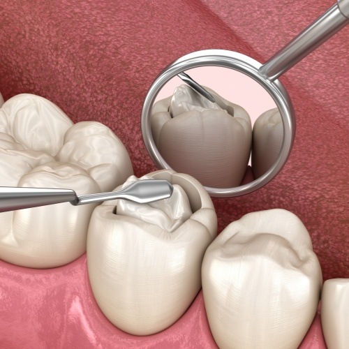 Closeup of animated smile during tooth colored filling process