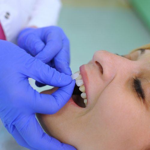 Dentist placing a veneer