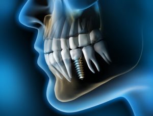 x-ray of implant