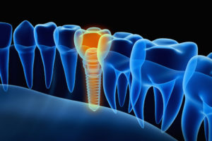 x-ray view of dental implant