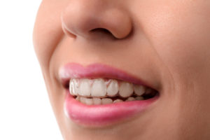 Woman with Invisalign clear braces