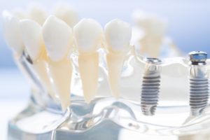 dental implants