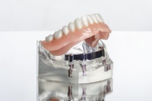 implant-retained dentures