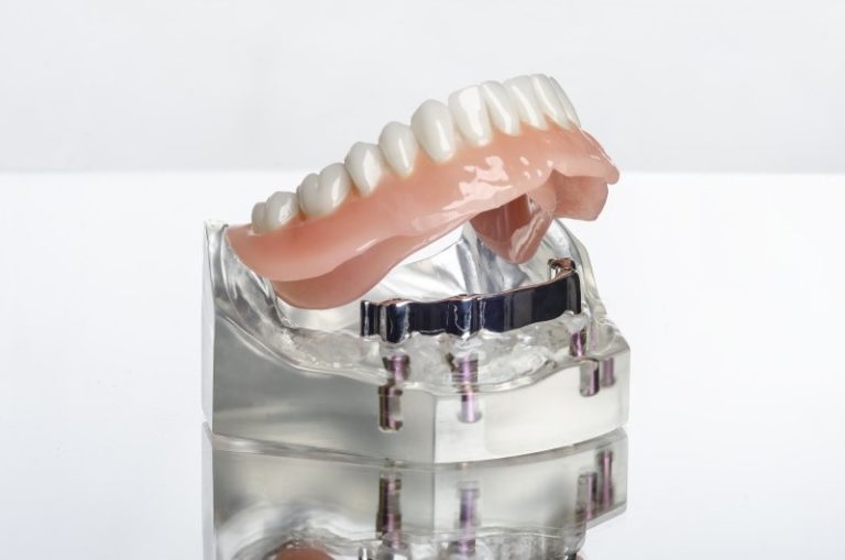 Does Delta Insurance Cover Dental Implants Awesome