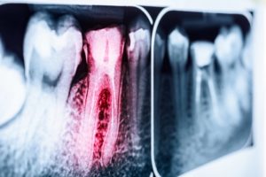 X-ray of an infected tooth