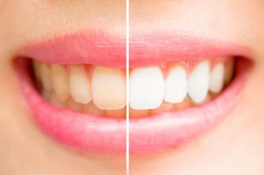 Whitening Before and After