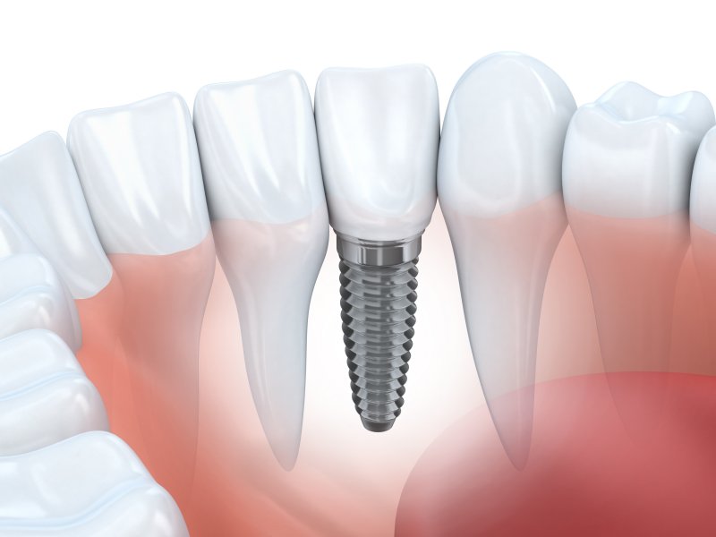 Close-up of dental implants