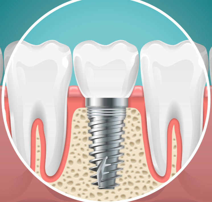 Illustrated cross section of a dental implant
